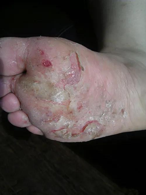 治疗脚气用什么药泡脚比较好,脚气怎么治疗用什么药效果好