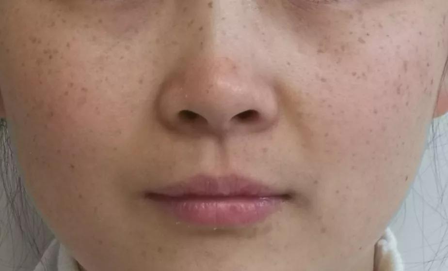 雀斑样痣是雀斑的一种吗,雀斑痣和健康痣有什么区别