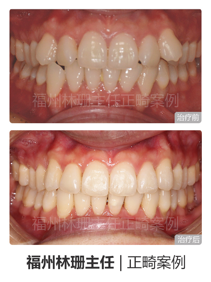 福州晋安哪里矫正牙齿,福州牙齿畸形龅牙矫正