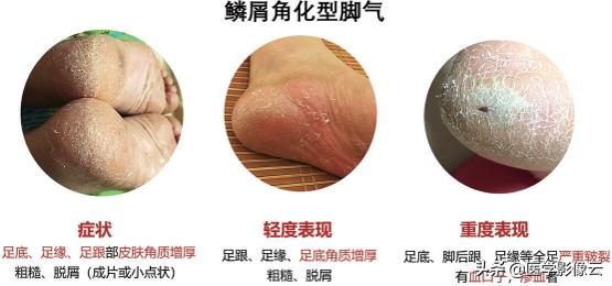 足部扁平苔藓,足癣病例