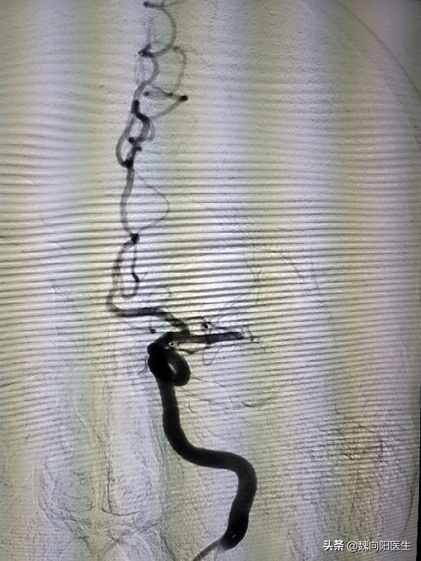 得了脑梗不敢出去怎么处理,得了脑梗不用怕生活自律是关键