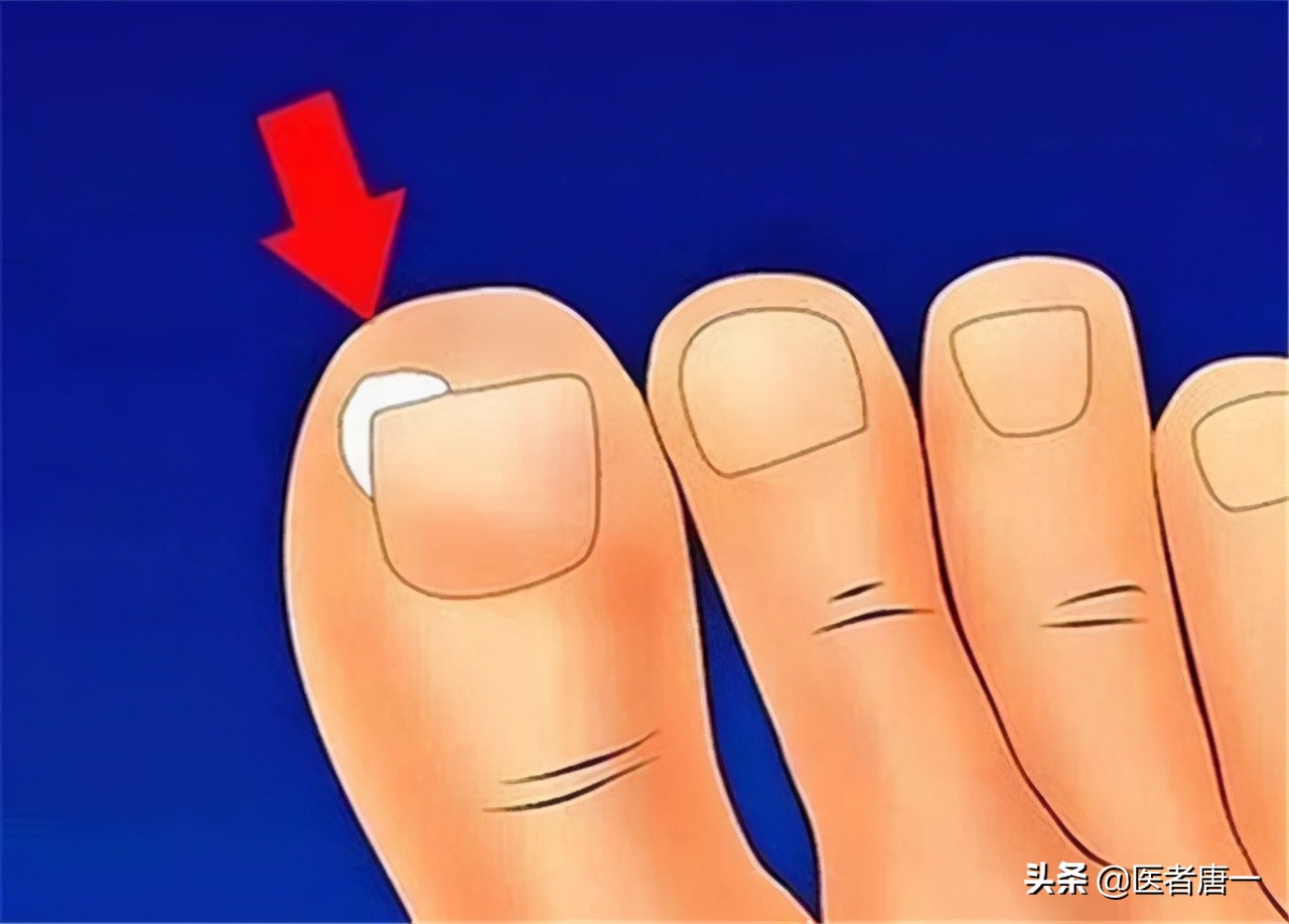 甲沟炎是不是治不好呀,甲沟炎对脚趾的伤害
