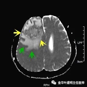 伴有脑转移了的肺癌能手术吗？