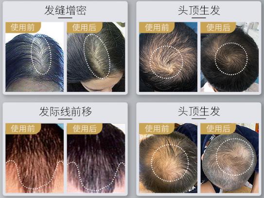 当今青少年脱发是怎么回事,青少年脱发的严重原因及补救方法