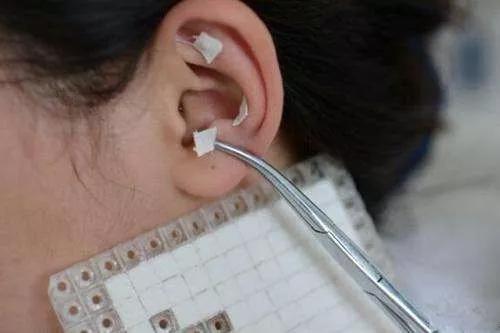 儿童近视眼贴耳豆好吗,儿童眼睛近视贴耳豆有效果吗