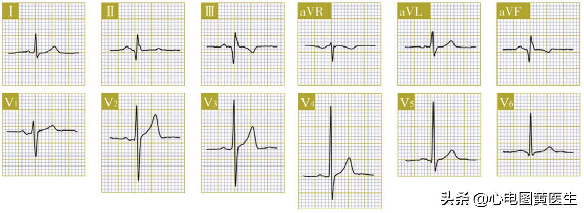 心电图q波异常但冠脉造影正常,病理性q波与异常q波心电图