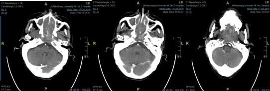 南大二附院耳鼻喉头颈外科在哪,南大二附医院耳鼻喉科一病区