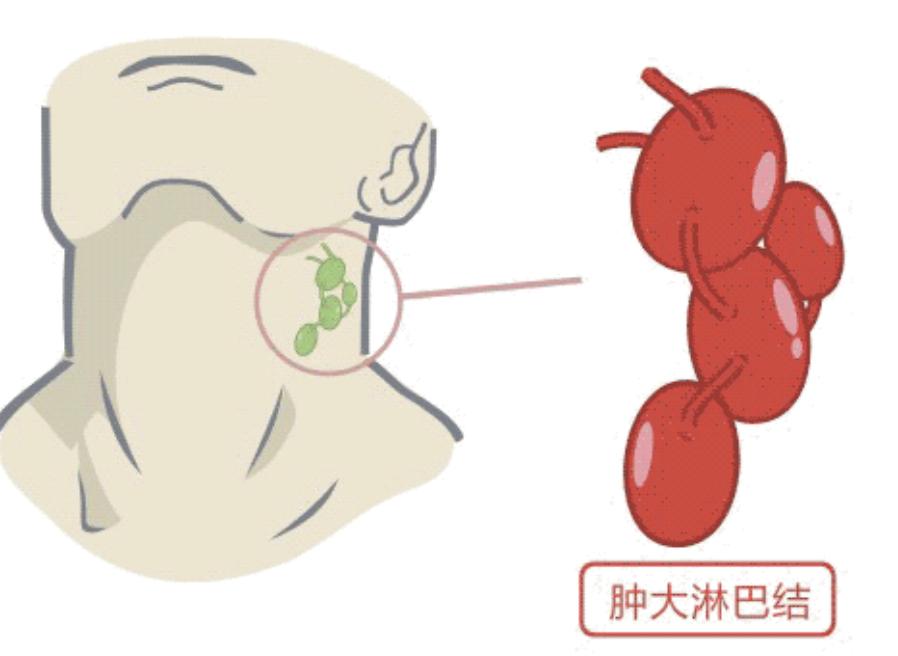 颌下淋巴结肿大预示什么,肺结核为什么引起淋巴结肿大