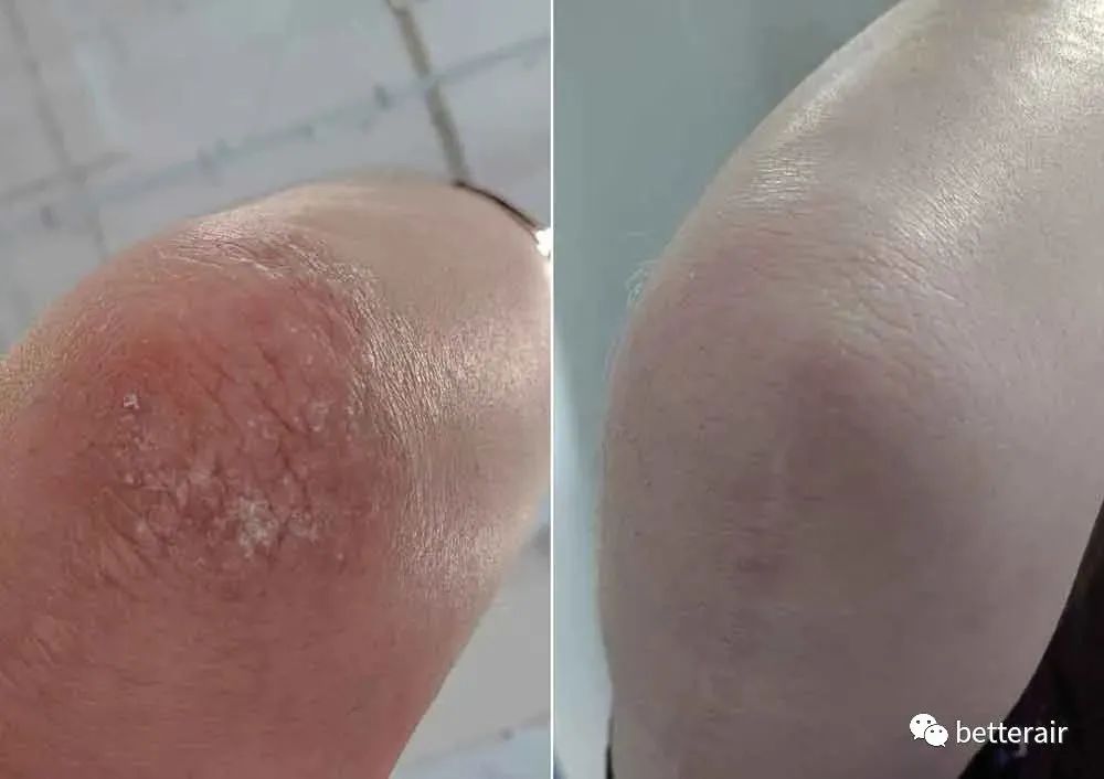 宝宝湿疹咳嗽流涕减轻,宝宝湿疹反复奇痒难忍