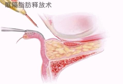 外切眶隔释放祛眼袋需要多少钱,外切眶隔释放祛眼袋真人案例