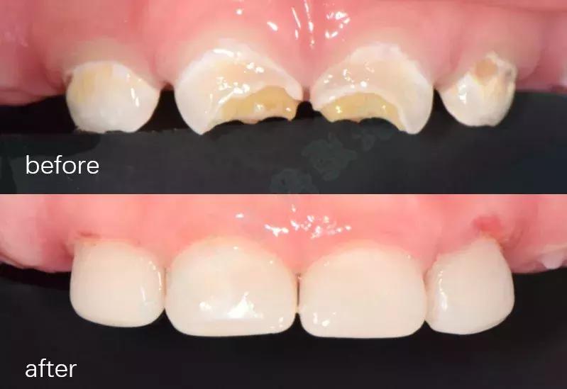 预防牙齿龋齿的工具推荐,乳牙龋坏的全过程