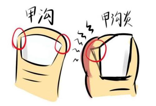 甲沟炎症状怎么治,甲沟炎是怎么引起的治疗方法