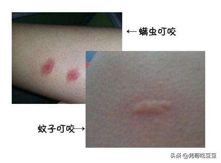 小宝宝被蚊子咬了怎么处理好一点,宝宝被蚊子咬了的处理方法