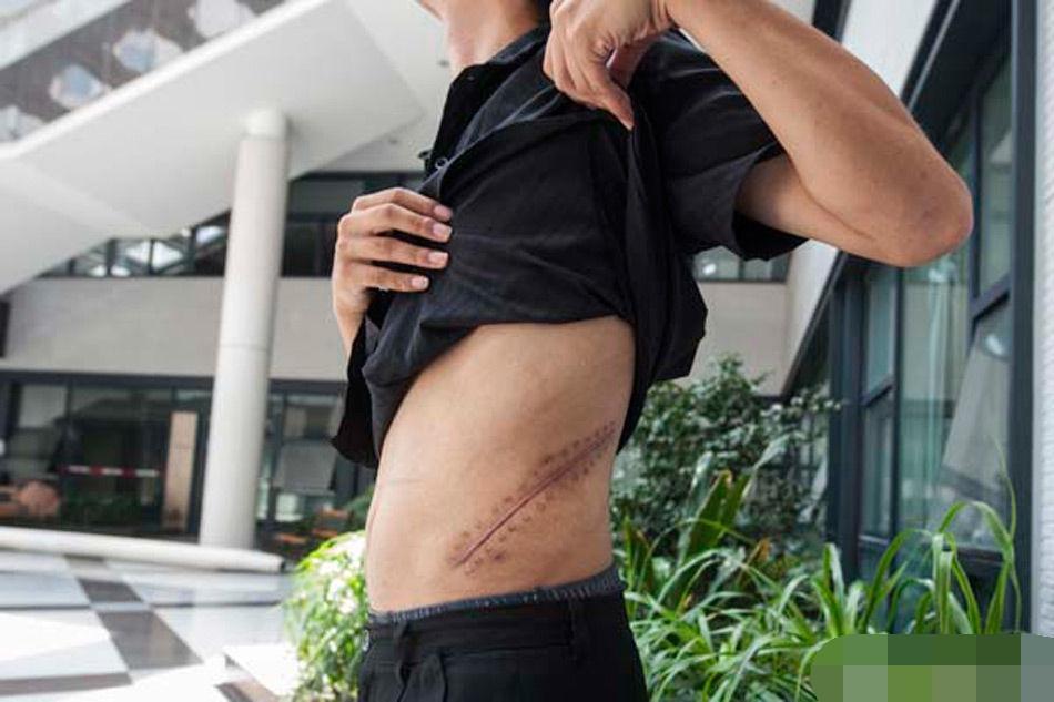 卖肾买苹果手机的男孩伤残了,专家告诉你合法捐献,也可以买手机