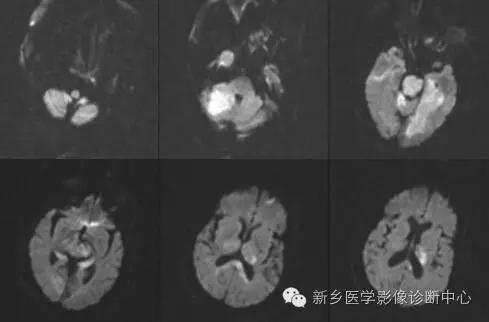 基底动脉尖综合征患者溶栓,基底动脉尖综合征名词解释