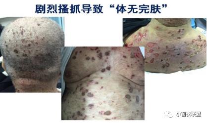 治疗皮肤瘙痒的有效药物是啥,皮肤瘙痒用什么药膏无激素