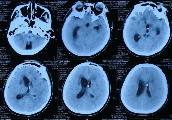 结核性脑积水,脑膜炎脑积水要治疗多久