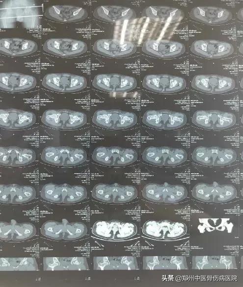 骨坏死中心疑难病例讨论：髋关节的剥脱性骨软骨炎的诊治