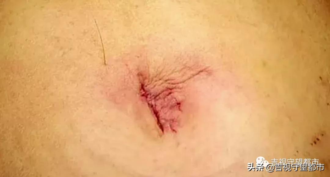 十几岁孩子得了卵巢囊肿,女子小腹大去检查卵巢囊肿