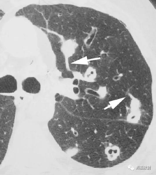 肺部感染并发症,老人新冠引起肺部并发症