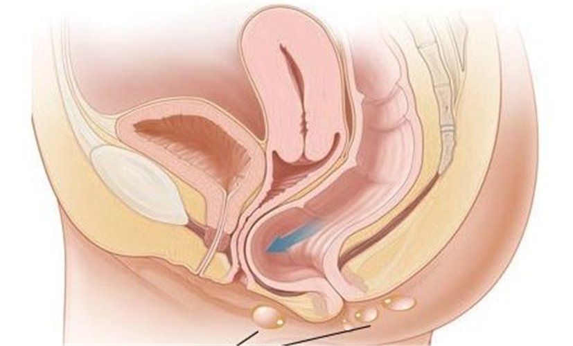 肛周湿疹是由脾湿引起的吗,肛周湿热引起的湿疹症状