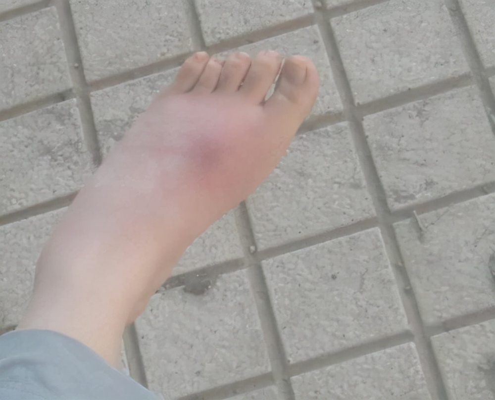 晚上在被子里发现蜈蚣,耳朵里取出蜈蚣