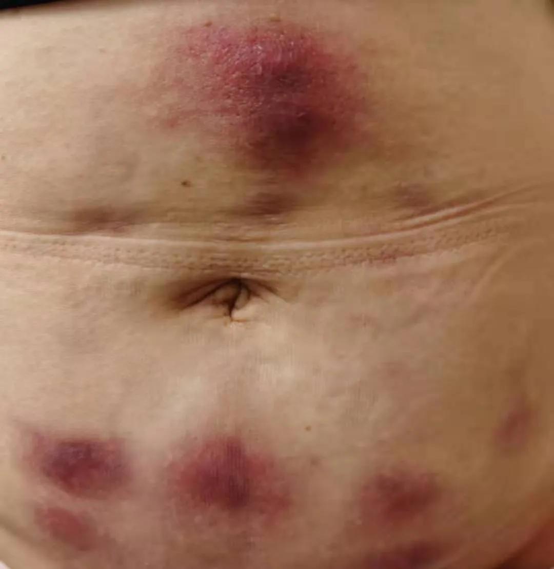 女子在美容院打溶脂针后续,女子打减肥针3天后皮肤溃烂