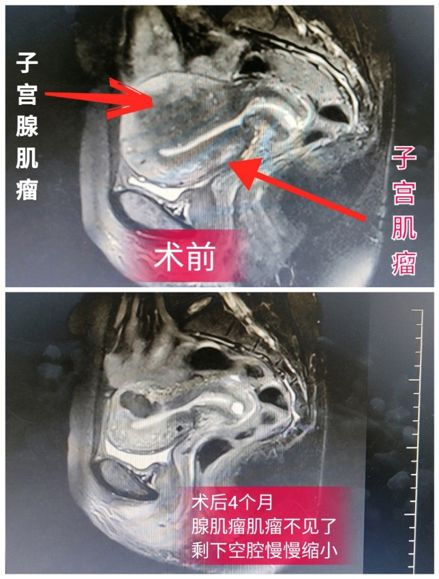 消除子宫肌瘤可用中药治疗吗,消除子宫肌瘤的特效药
