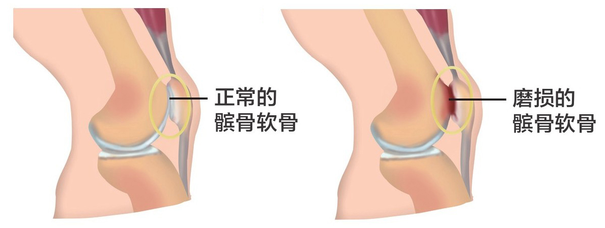 年轻人髌骨软化能不能恢复,年轻人的髌骨软化症是残废了吗