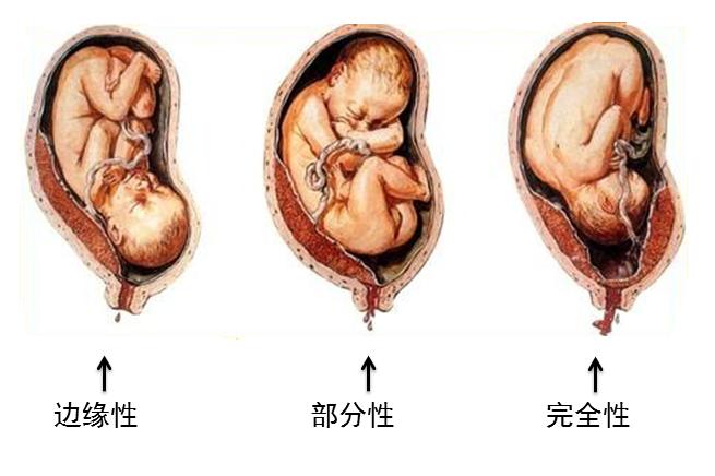 前置胎盘的主要护理诊断是什么,前置胎盘剖腹产要几个医生