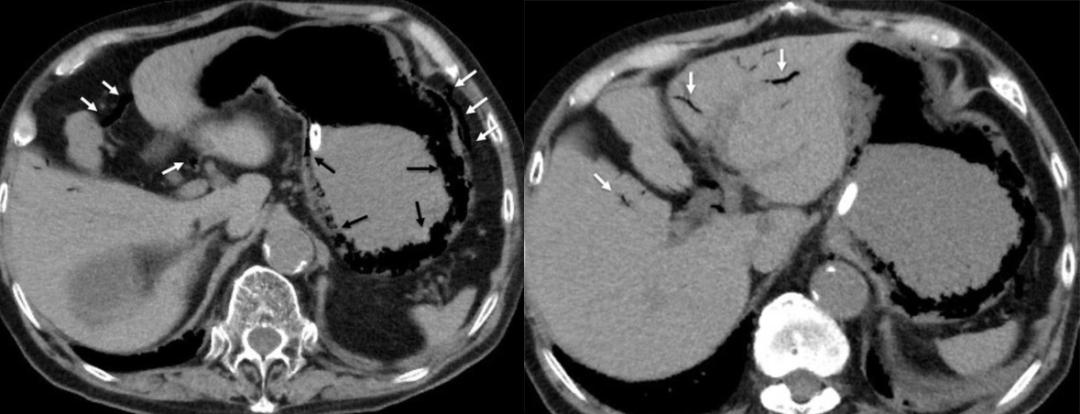 腹部ct能看出来胃的毛病吗,如果胃有问题腹部ct看得出来吗