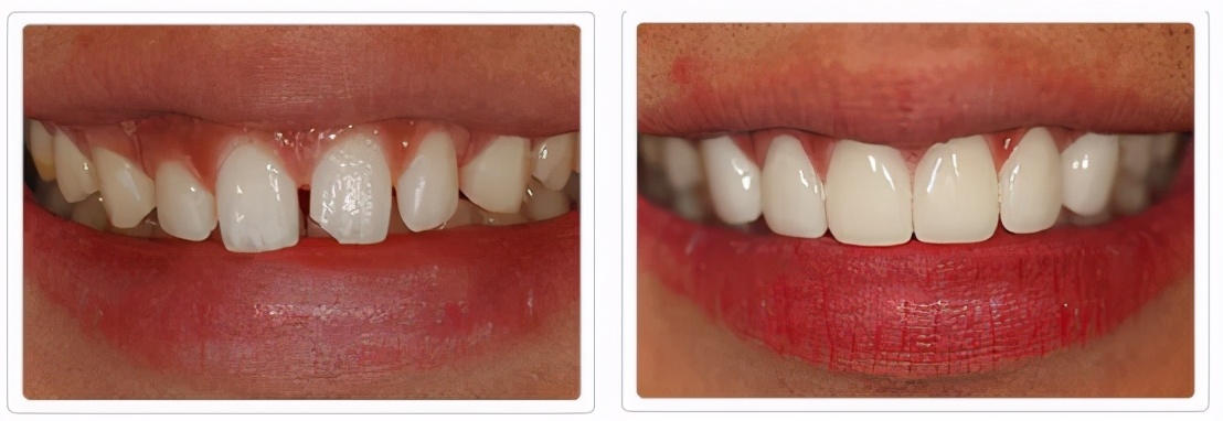 什么方法最适合去黄牙不伤牙齿,一口老黄牙怎么治疗