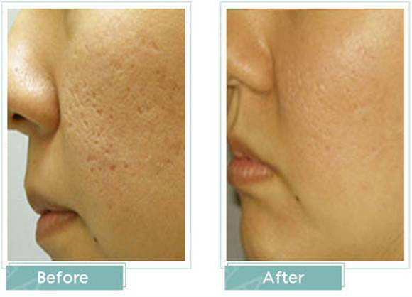 毛孔粗大又有痘痘如何改善,毛孔粗大有痘痘如何护肤