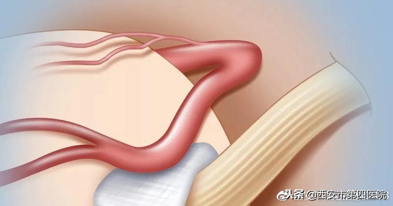 非典型面肌痉挛如何治疗,面肌痉挛最好的治疗方法