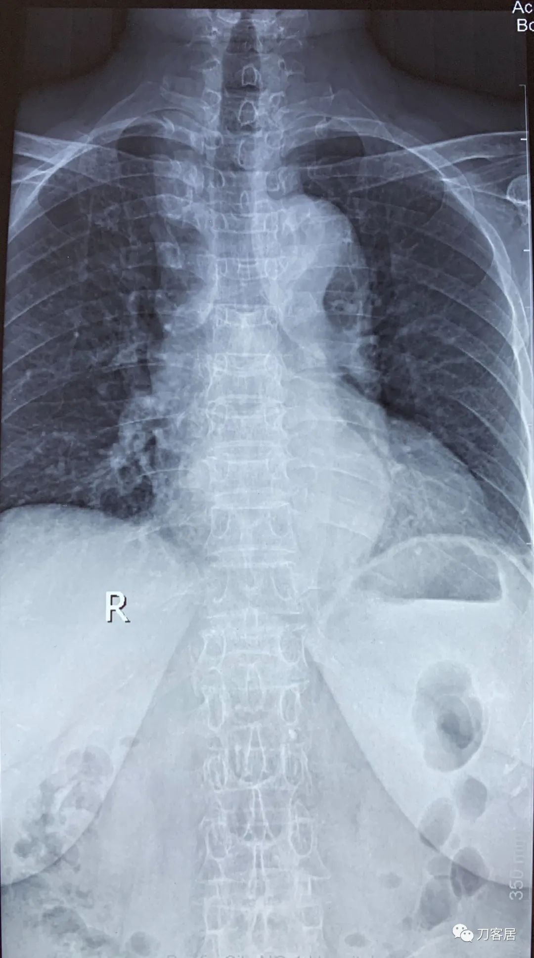 胸椎压缩性骨折病历,脊柱骨质疏松性压缩性骨折