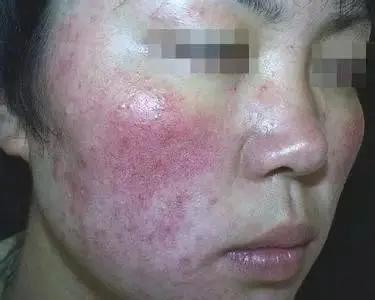 美容不成反毁容的案例,美容不做了皮肤会越来越差