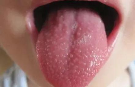 春天,宝宝皮疹的高发期!家长看看怎么辨别皮疹和护理!