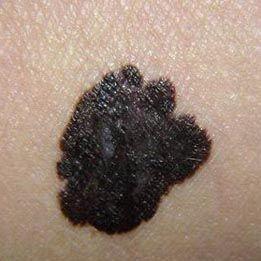 黑毛痣做了激光还会恶化吗,黑毛痣上毛发脱落一定是恶化吗