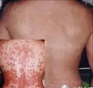 用药后身上起红疹子,用药后的红疹会自己消退吗