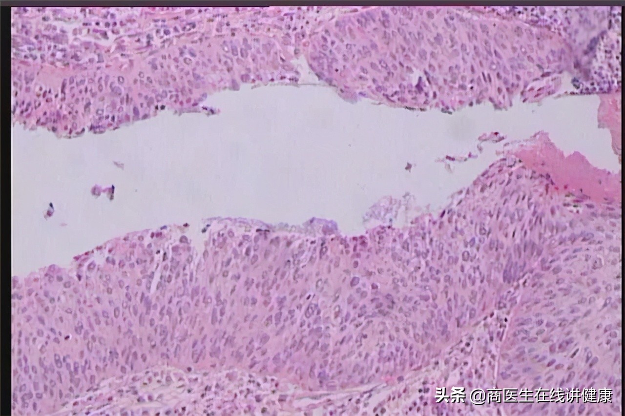 几个月内形成的浸润癌易复发么,浸润癌恶性