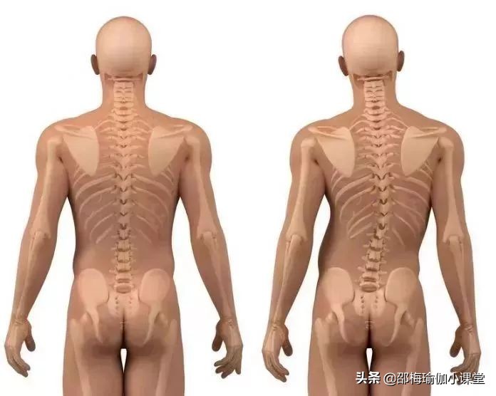 脊柱侧弯出现长短腿是多少度,脊柱侧弯长短腿怎么锻炼矫正视频