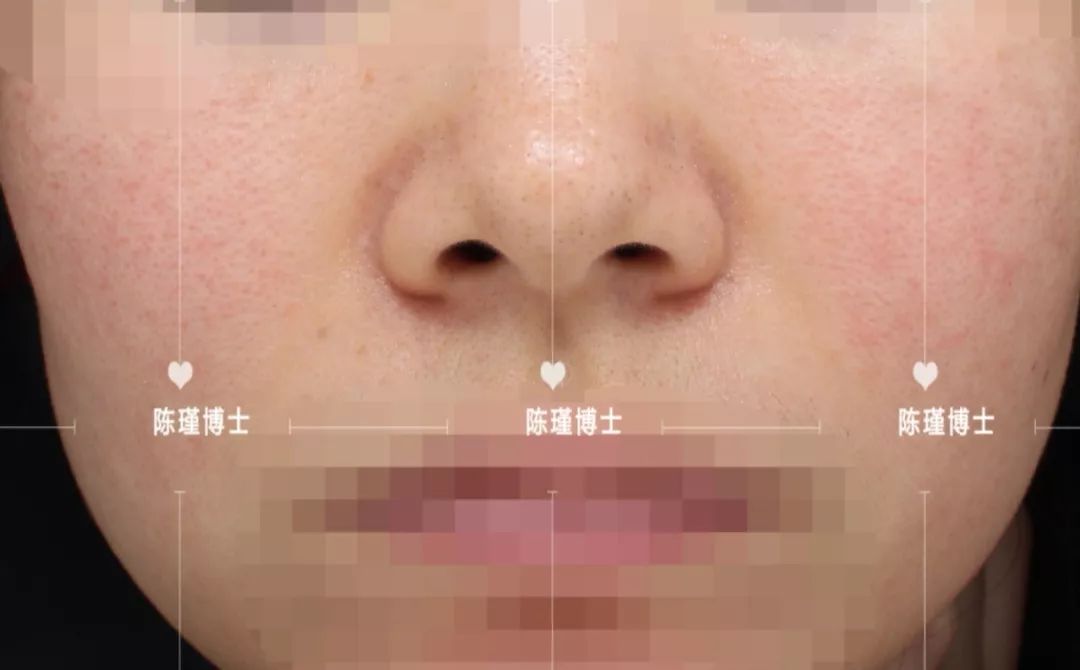 痘痘肌怎么刷酸效果好,痘痘肌刷酸的正确方法