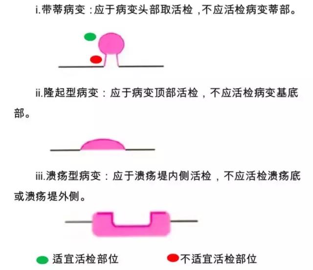 胃癌中医诊疗方案2018,胃癌筛查规范