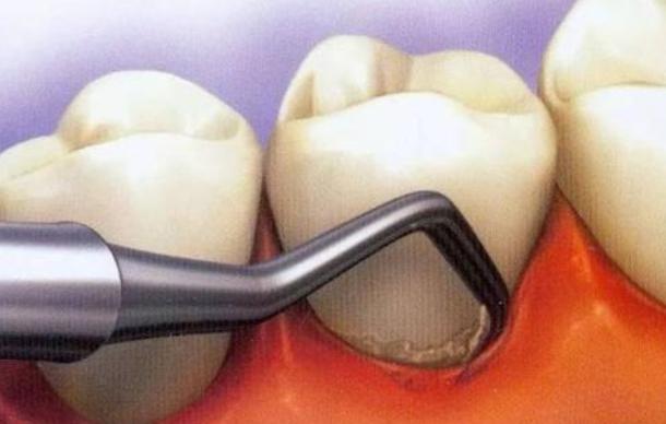 牙龈萎缩为什么不可逆,牙龈萎缩龈下刮治后萎缩更严重