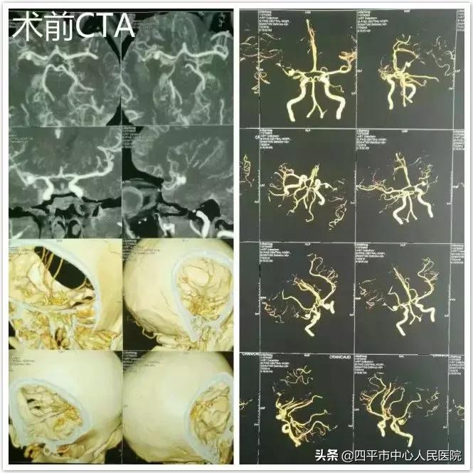 精准排雷再现新高—神经外科在6月份成功救治6例颅内动脉瘤患者