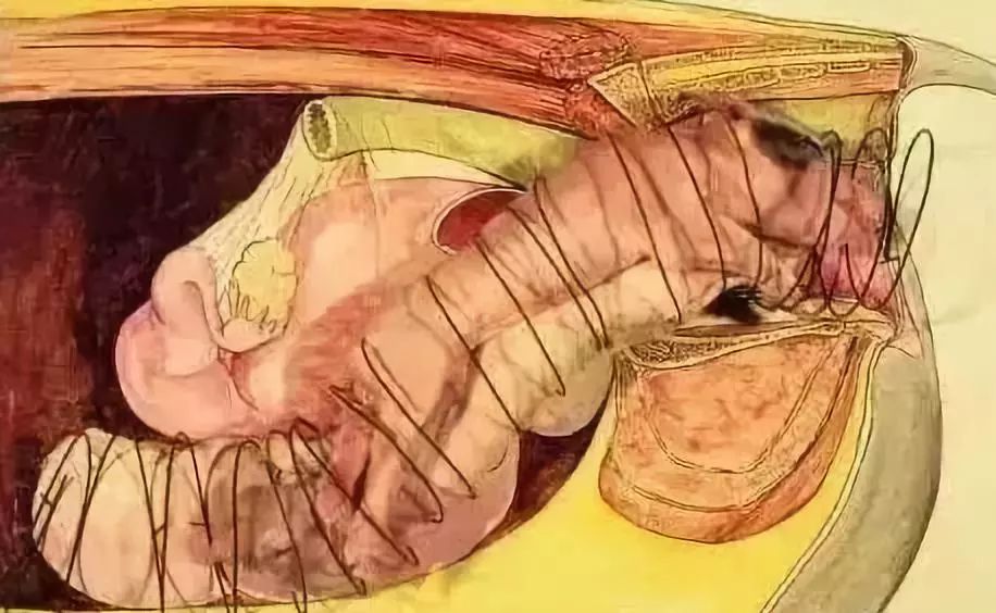 母猪难产掏小猪示范教程,怎样掏难产的母猪