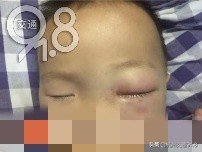 男孩眼睛被淋入辐射液体,杭州小孩右眼被可乐给腐蚀
