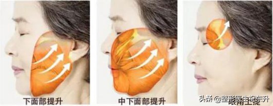 拉皮手术可以去除眼下细纹吗,拉皮手术能去除苹果肌吗