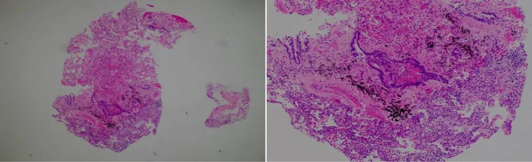 特发性肺炎一直用激素治疗,机化性肺炎住院治疗使用什么药物