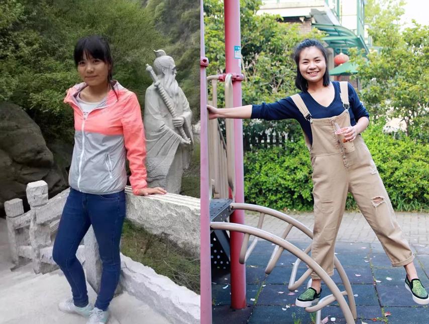 颧骨突出微调填充,颧骨外扩是要磨骨还是填充